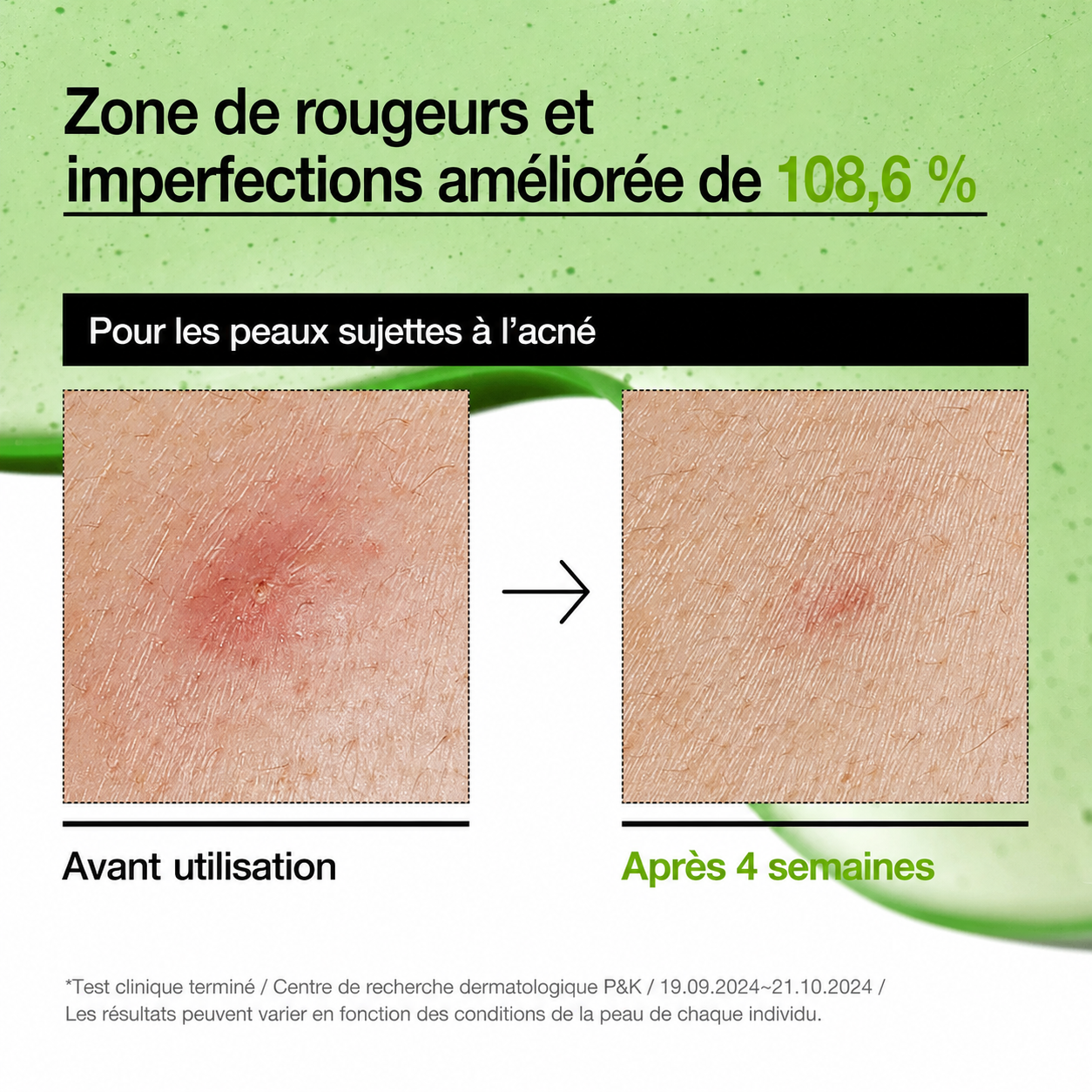 Before and after comparison of skin redness and imperfections with text on a green background
